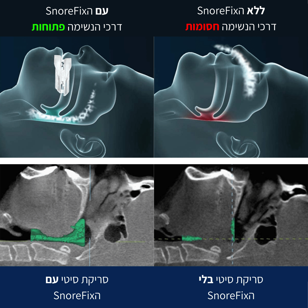 הפסיקו לנחור והחזירו שקט לשינה ולזוגיות עם SnoreFix - BLISS SHOP