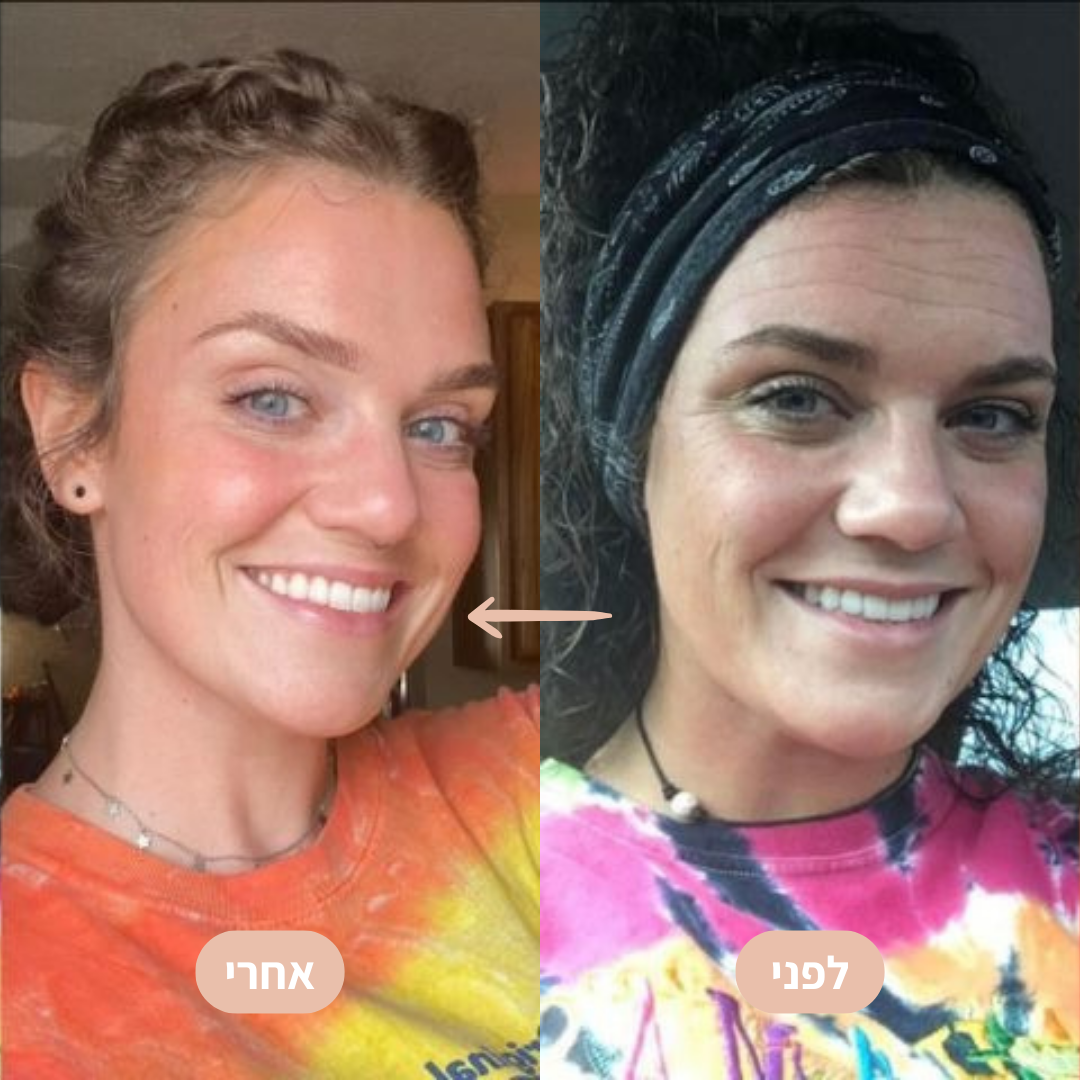 SkinFix - יריעות סיליקון לטיפול בצלקות וקמטים - BLISS SHOP