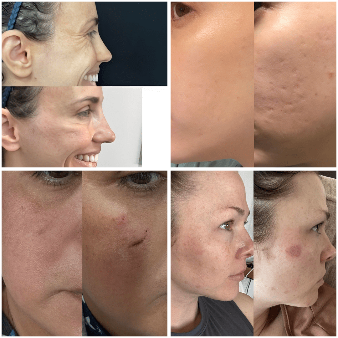 SkinFix - יריעות סיליקון לטיפול בצלקות וקמטים - BLISS SHOP